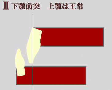 下顎が過成長