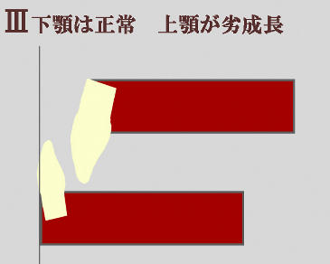 上顎が発育不全