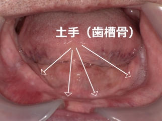 下顎総入れ歯の難症例