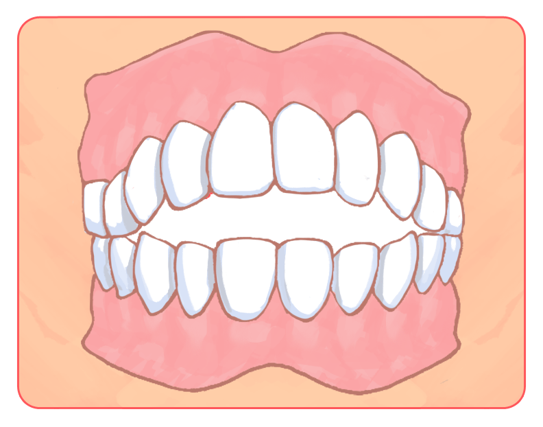 開咬（前歯が噛み合わない）