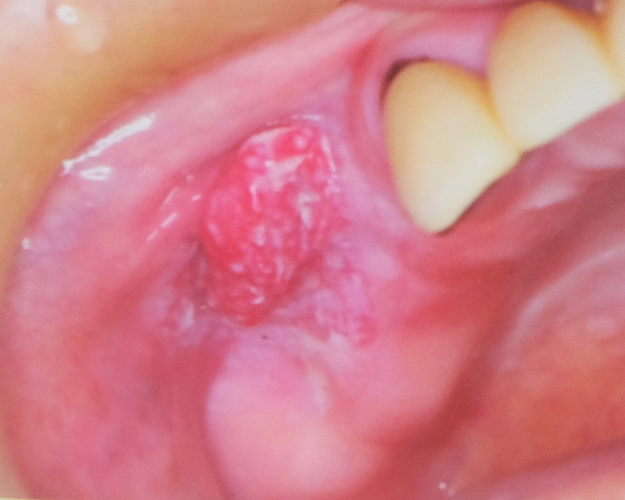 歯茎の歯肉癌
