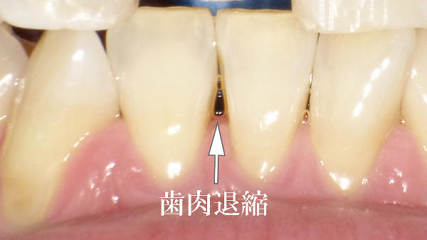 矯正治療後の歯肉退縮