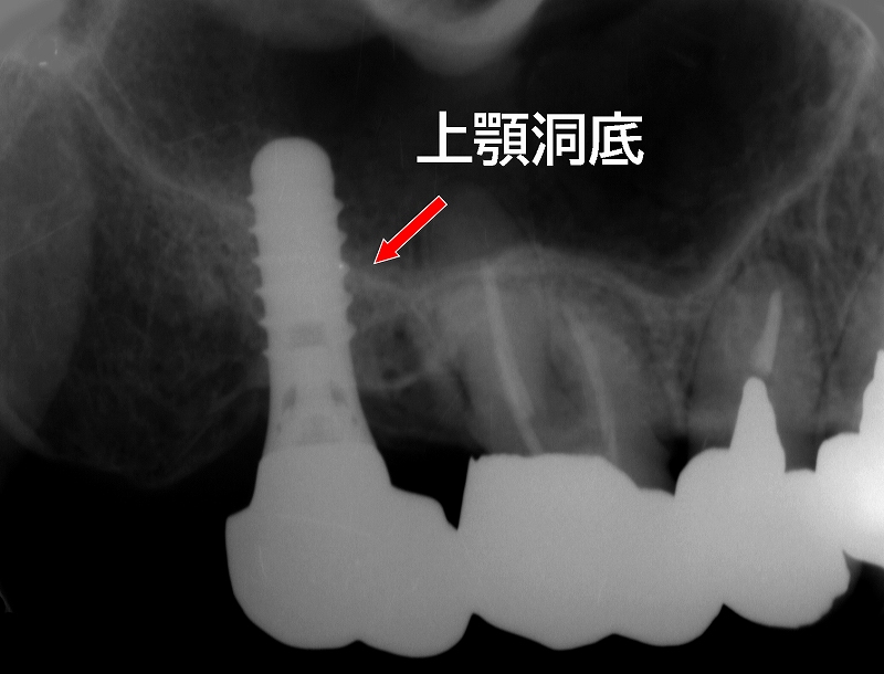 上顎洞穿孔やインプラント体の上顎洞迷入
