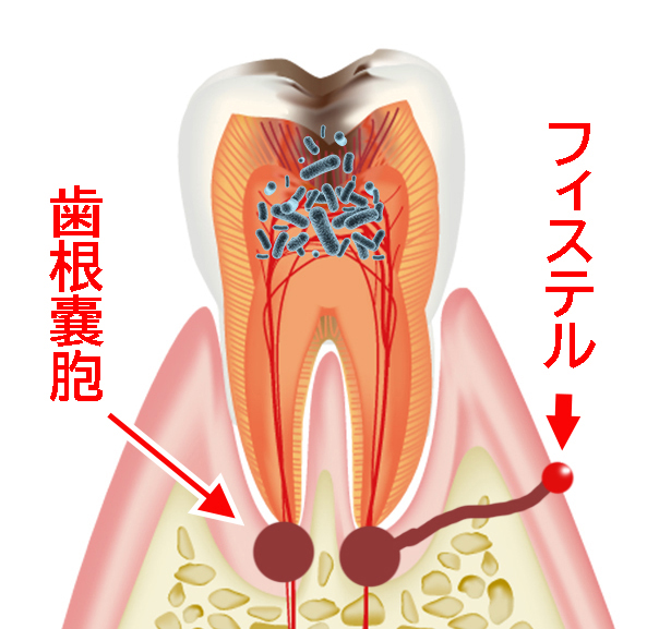 フィステルとは？