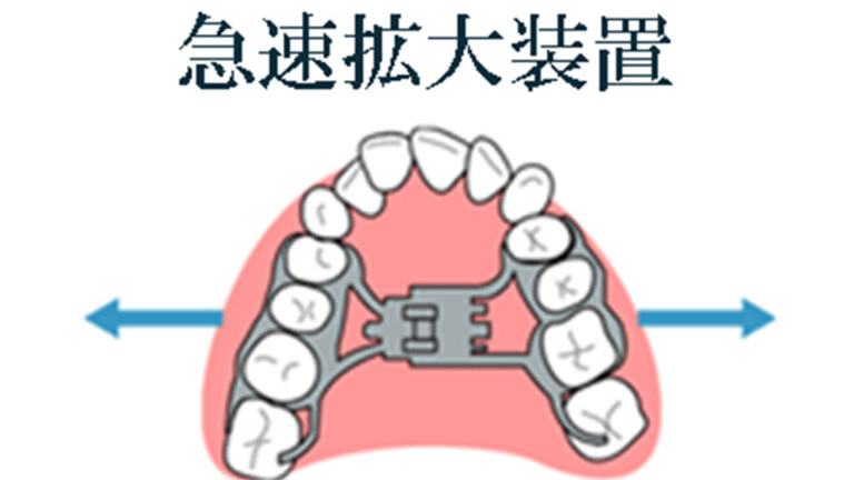 急速拡大装置