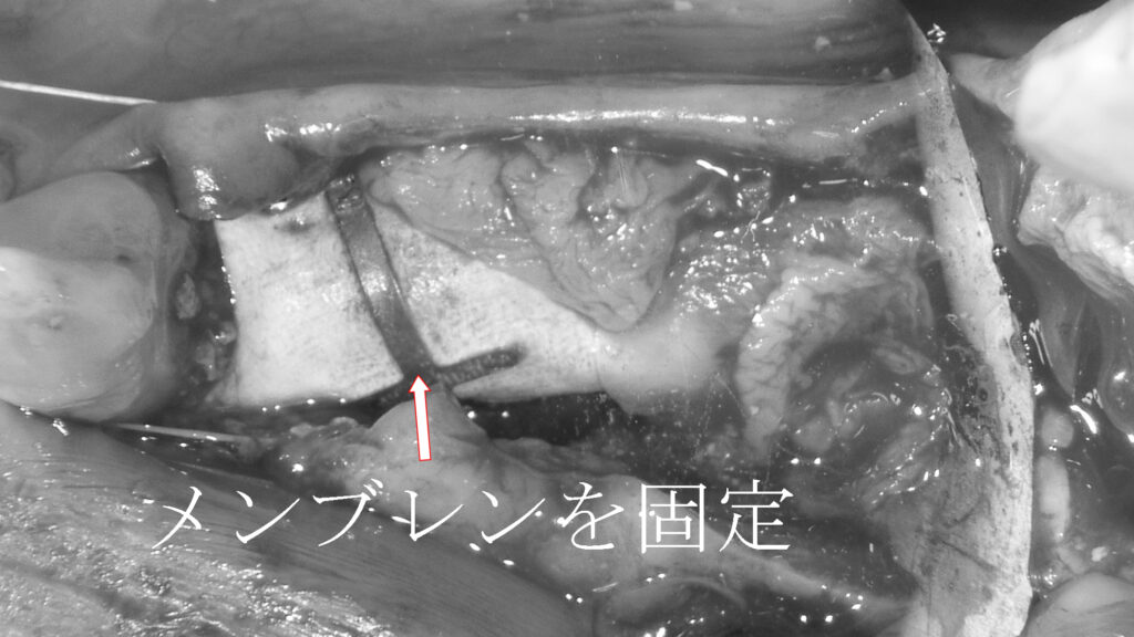 メンブレン（膜）をチタンで固定