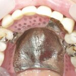 金属床義歯とレジン床義歯の比較
