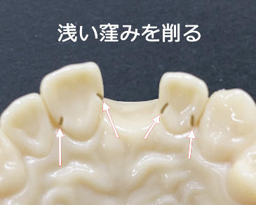 前歯の裏側に浅い溝を削る