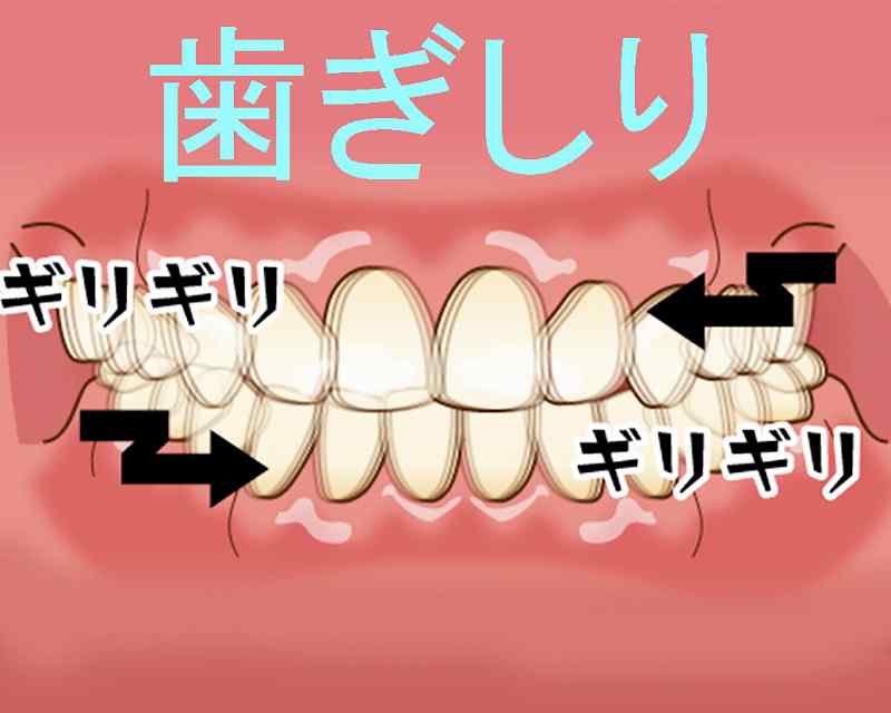 歯ぎしりによる骨や上部構造の破壊