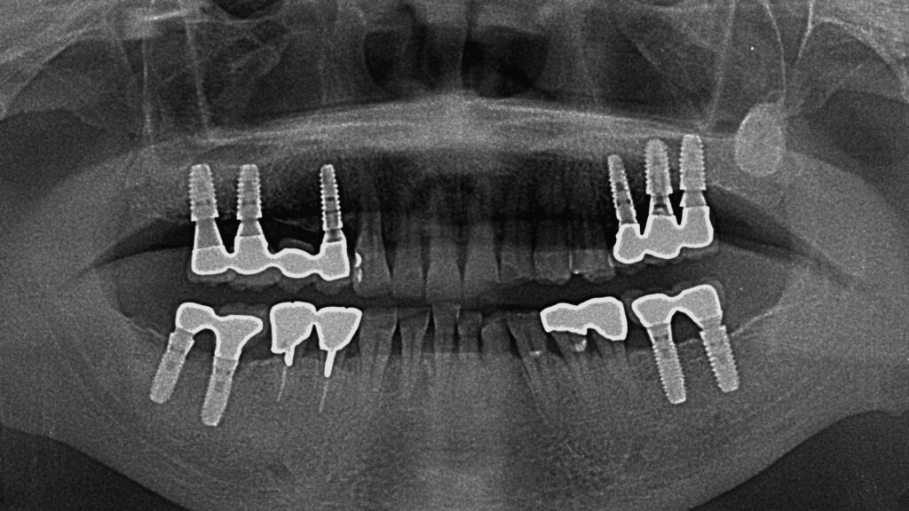 上顎に６本、下顎に４本のインプラント