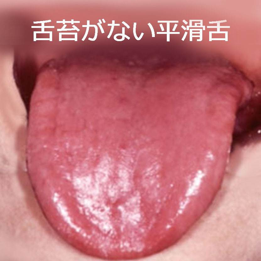 舌苔が無い平滑舌