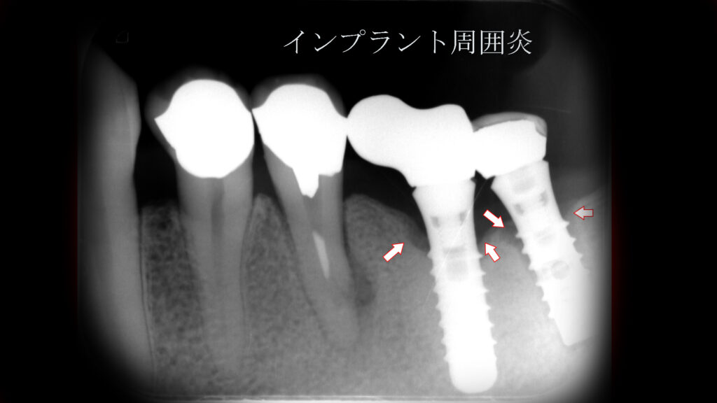 インプラント周囲炎