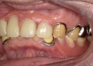 40代-50代で初めての部分入れ歯