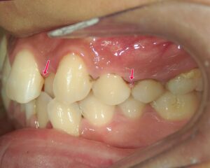 歯並びが悪いとどうなる？