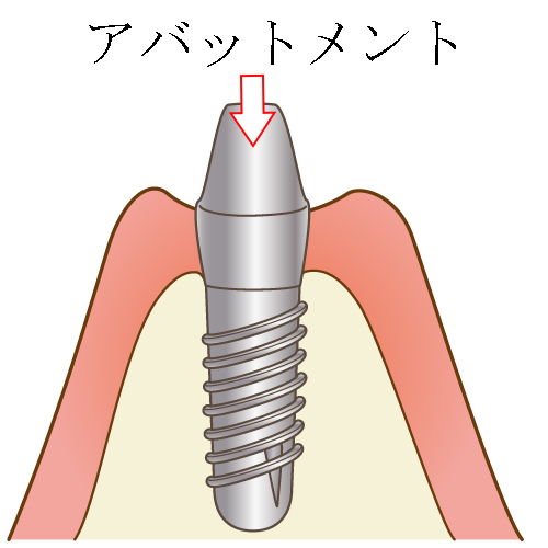 アバットメント