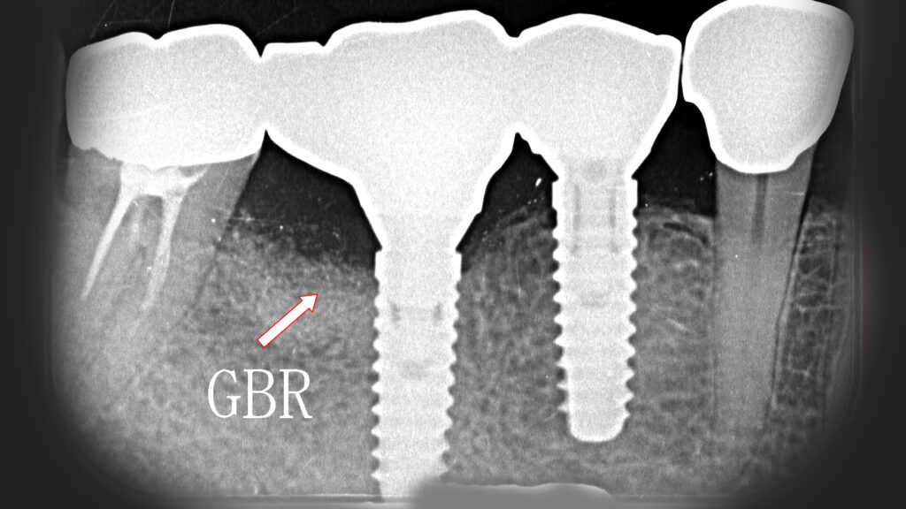 GBRにより骨造成が出来ているレントゲン画像