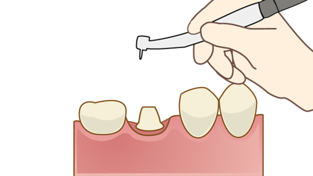 歯を削る