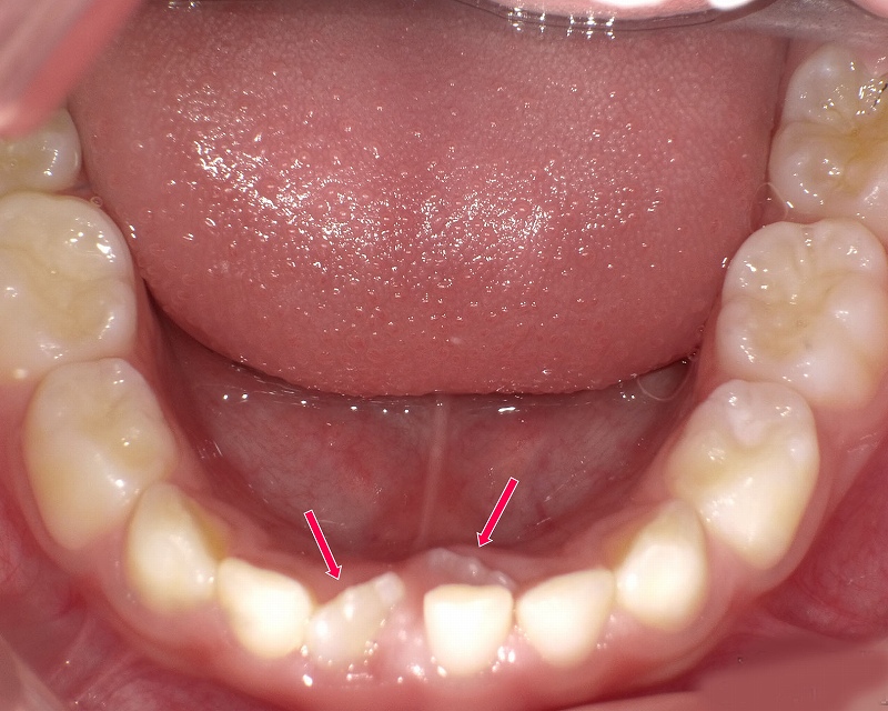 １本の下顎中切歯が内側から生える