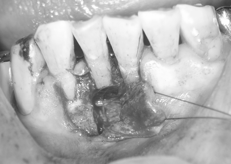 歯根嚢胞摘出術＋歯根端切除術