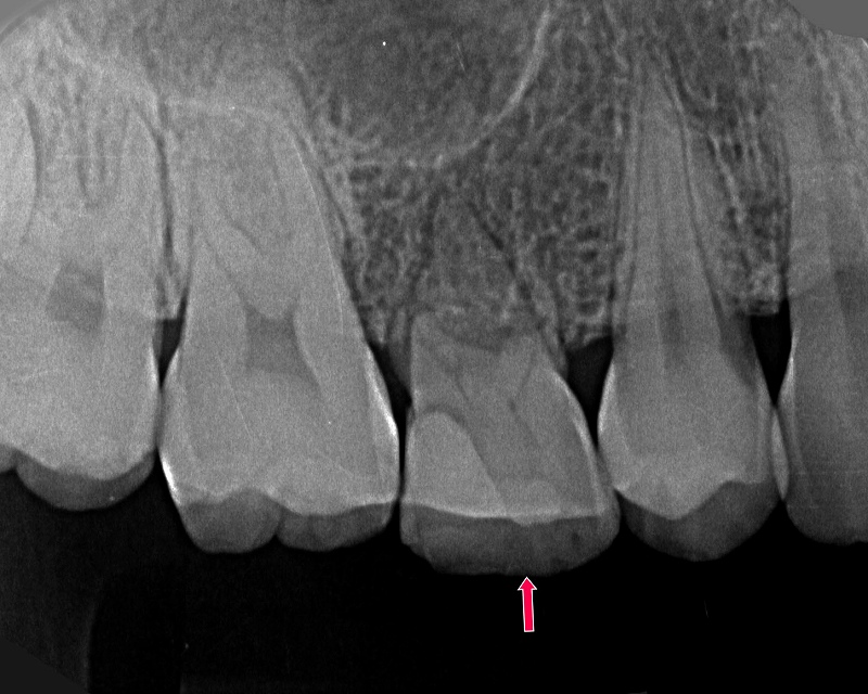 上顎第二小臼歯胚の先天欠損