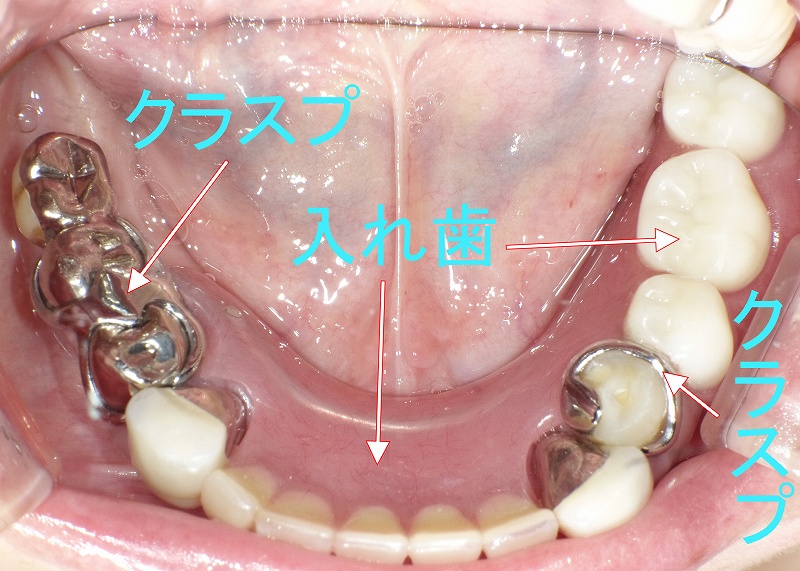 下顎にレジン床義歯