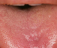 舌乳頭（糸状乳頭）