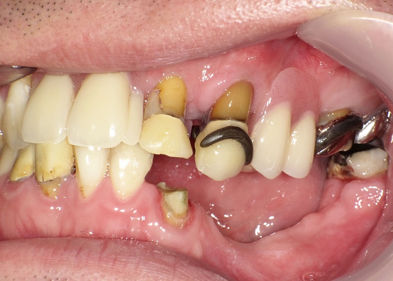 歯の状態チェック