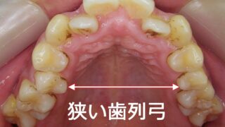 狭窄歯列弓のすべて｜V字型の歯並びが気になる方へ【子ども
