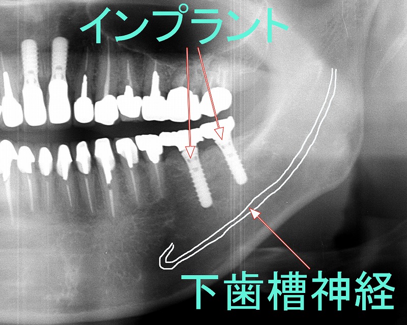 インプラントを入れるためには麻酔下において手術が必要です。

手術の際、下顎の奥歯であれば下歯槽神経（下顎神経）の損傷