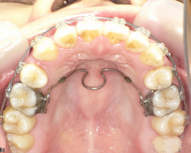 トランスパラタルアーチとワイヤー矯正の併用