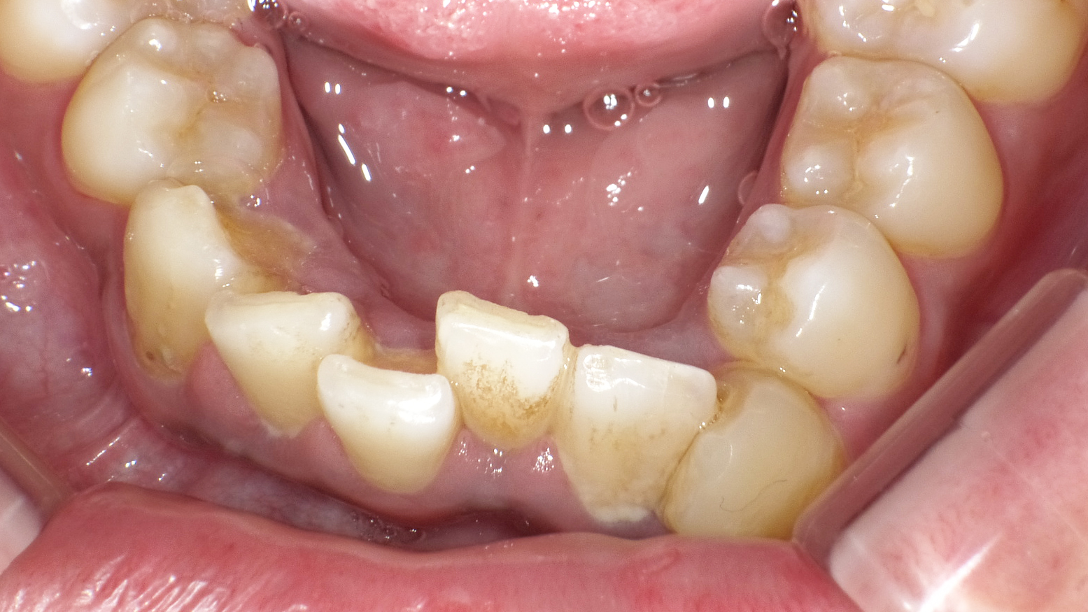 初期歯周病で乱杭歯の症例