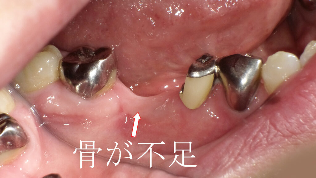 骨が不足している下顎の６番