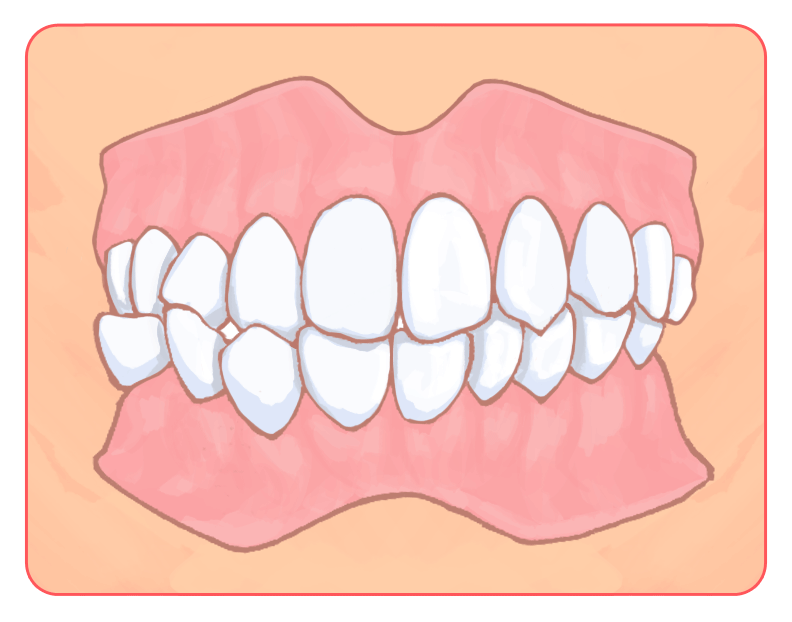 交叉咬合（噛み合わせのズレ）