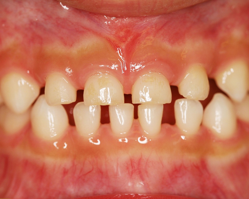 赤ちゃんの前歯の乳歯に大きな隙間