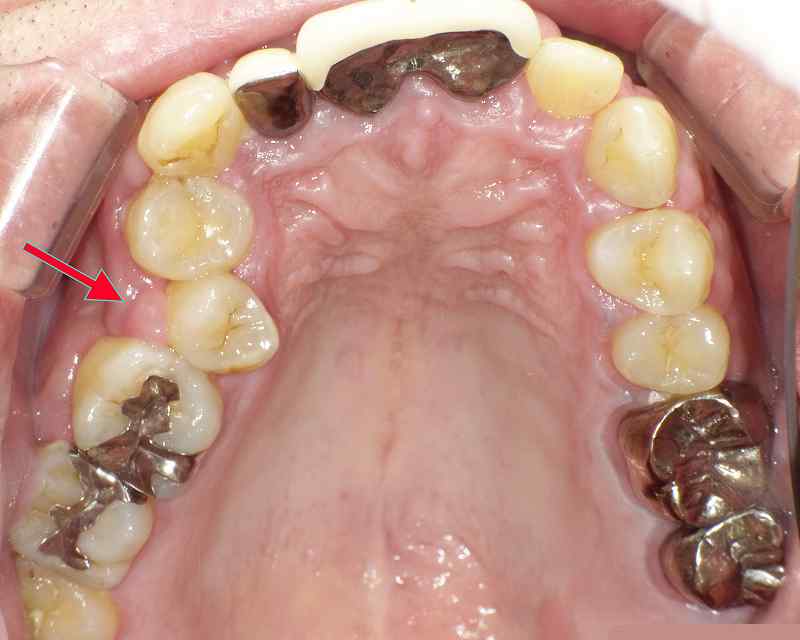 歯周病の上顎咬合面観