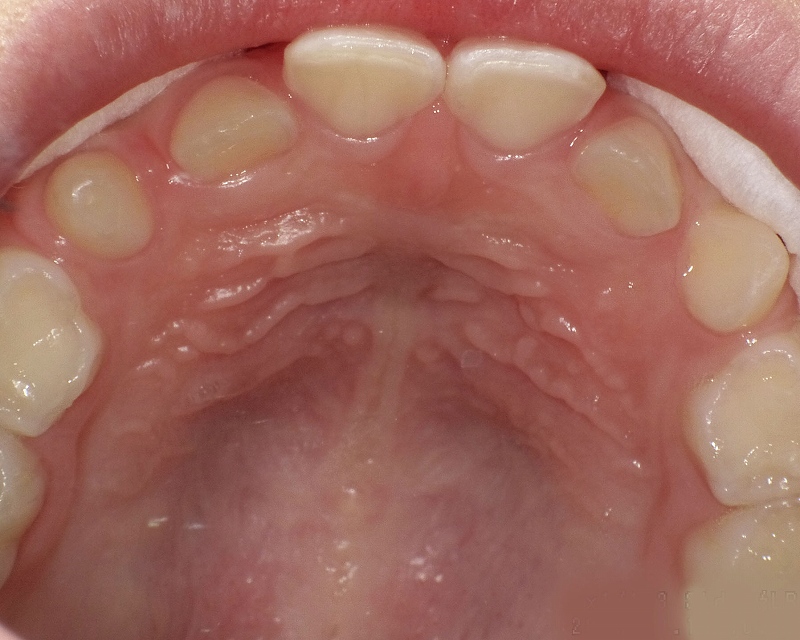 上の前歯の乳歯に隙間がある赤ちゃん