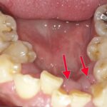 歯周病でも歯列矯正は出来るか？