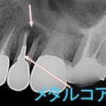歯根破折の原因と初期症状