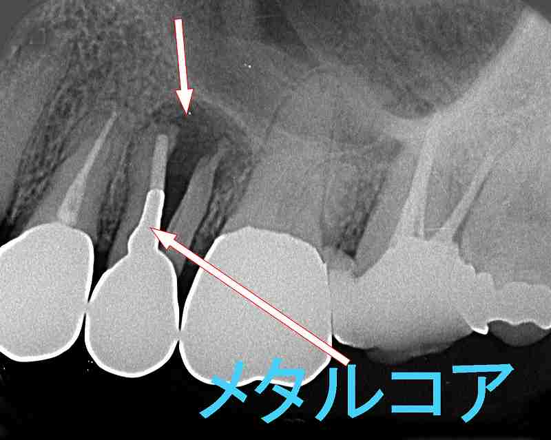 歯根破折した第二小臼歯