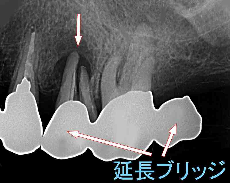 上顎第2小臼歯が歯根破折
