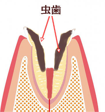 差し歯の歯根が大きな虫歯