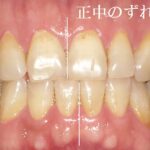 歯の正中線のずれの治し方