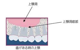 上顎臼歯部歯根と上顎洞底が接近