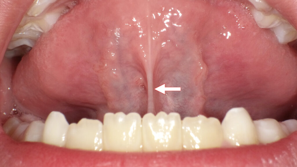 正常な舌小帯