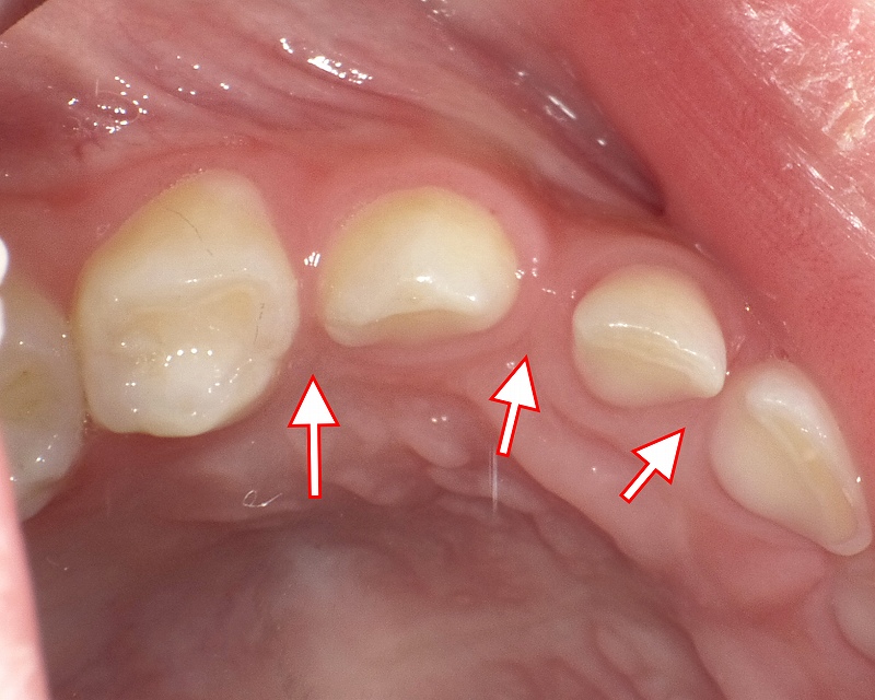 乳歯AB間、前歯と乳犬歯、乳犬歯と第1乳臼歯間に隙間