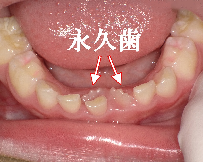 6歳児の前歯（永久歯）が内側から生える