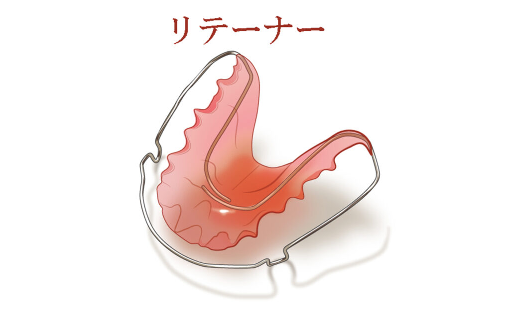 リテーナーとは？矯正治療後に欠かせない保定装置の役割と正しい使い方