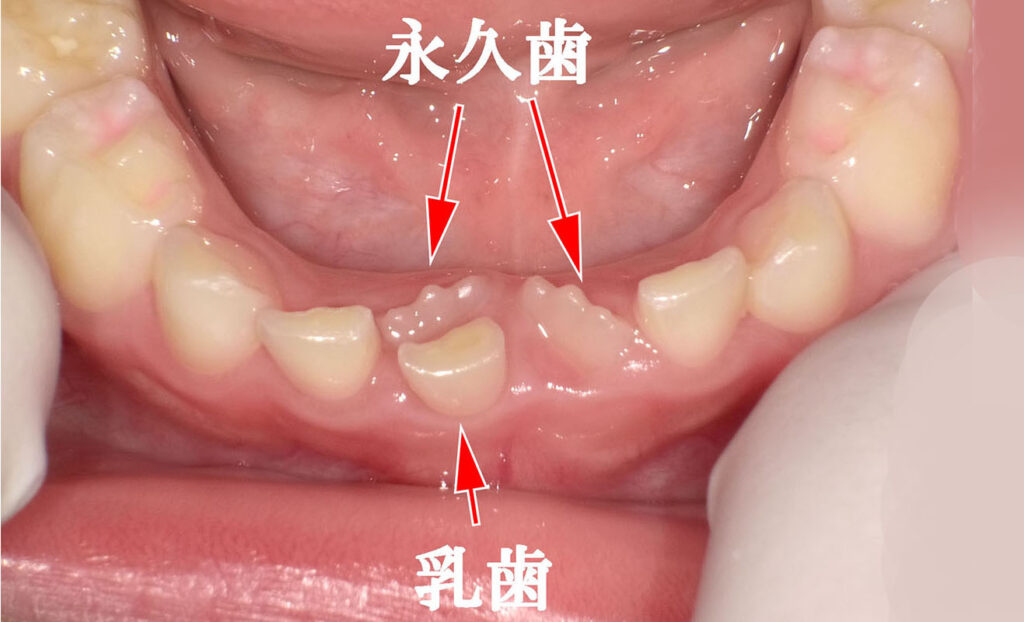 歯 24 ストア 本 少ない