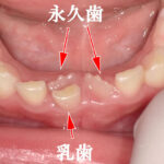 乳歯が抜けず内側から永久歯