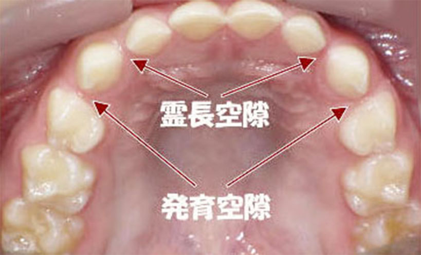 上顎の発育空隙と霊長空隙